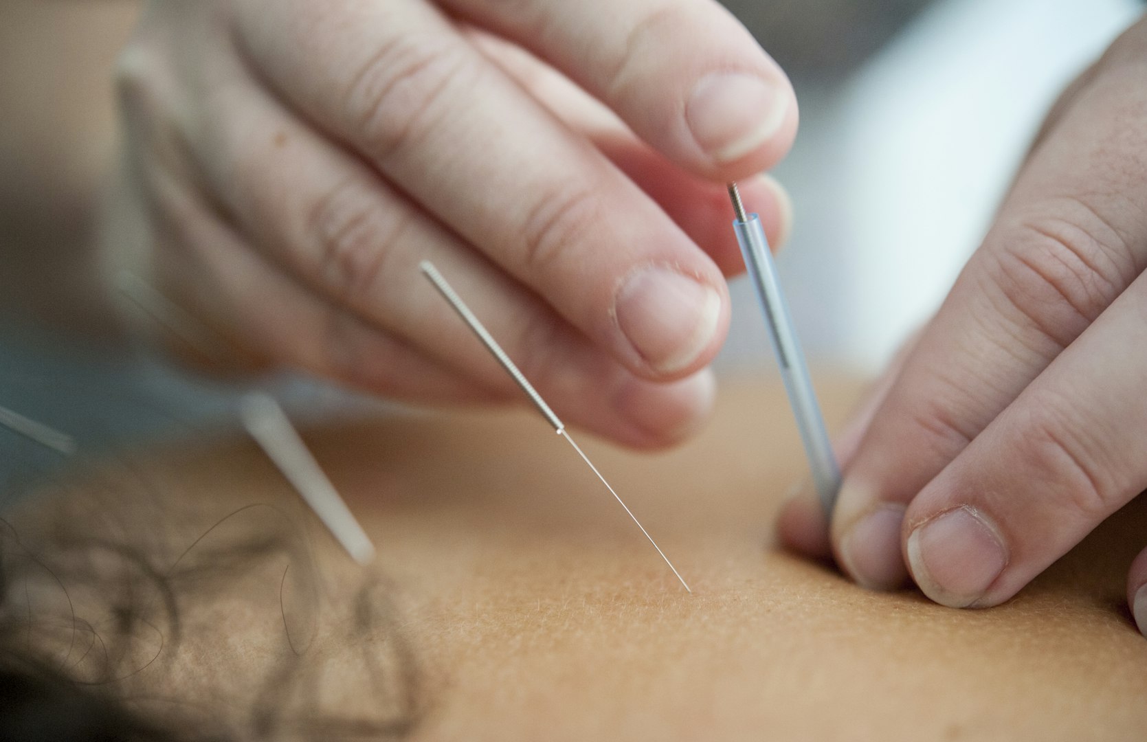 Vilcabamba accupuncture